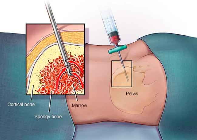 biopsy.png